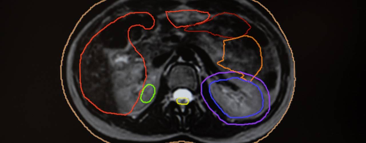 Adaptación diaria. MR Linac. Clínica Universidad de Navarra