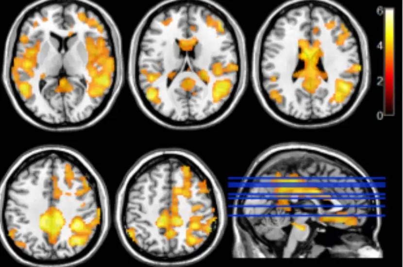 img-vascular-pet-alzheimer