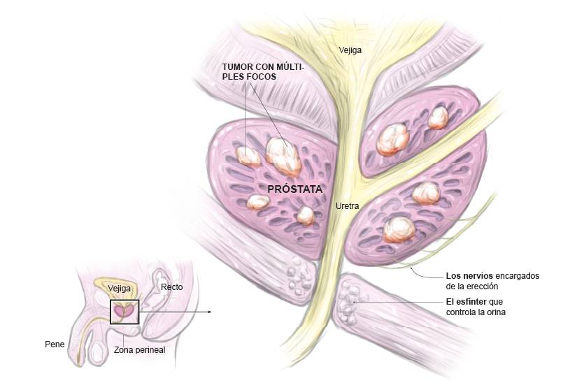 Infografía detalle cáncer de próstata. Infografía para explicar el cáncer de próstata.