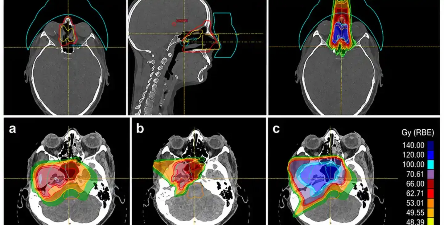 Imagen radiológica de cómo la protonterapia concentra la radiación en el tumor durante una reirradiación en un paciente de la Clínica Universidad de Navarra.