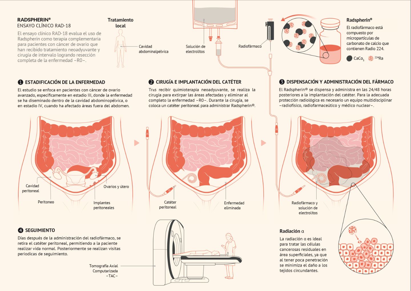 Ensayo-clinico-radspherin Infografía de la aplicación del Radspherin en un ensayo clínico del Cancer Center Clínica Universidad de Navarra para pacientes con cáncer de ovario.