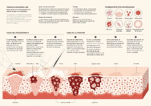 Rhenium-SCT, nueva terapia para los cánceres de piel no melanoma Infografía sobre el Rhenium-SCT, nuevo tratamiento para el cáncer de piel no melanoma