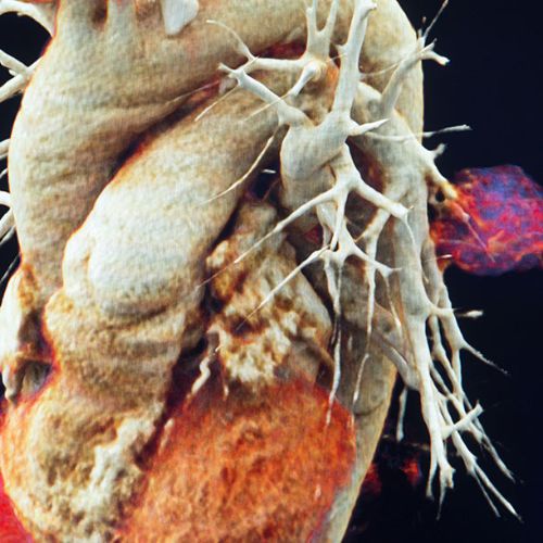 recreacion-3d-cancer-pulmon