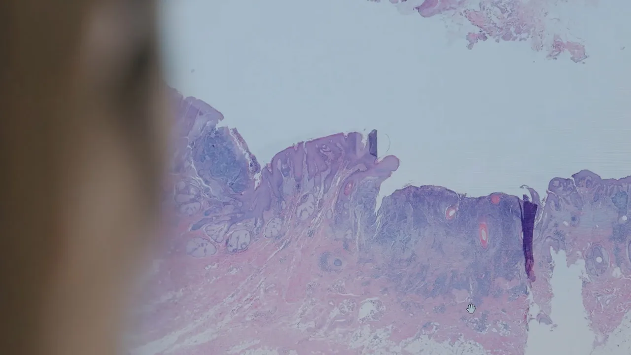 Imagen de muestra de cáncer de piel después de una cirugía de Mohs. Clínica Universidad de Navarra