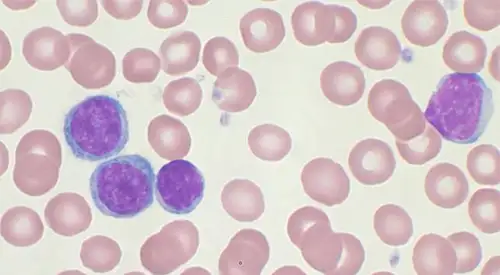 img-leucemia-microscopio <p>Imagen de un microscopio de una muestra de sangre de un paciente con leucemia </p>
