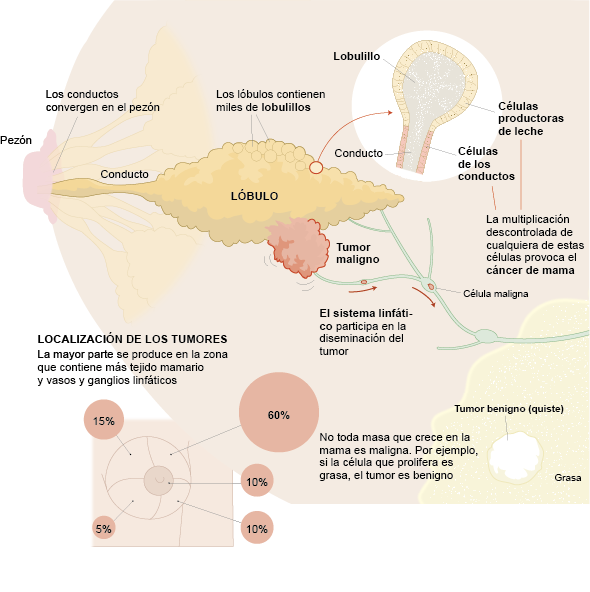 Detalle de una mama con cáncer.