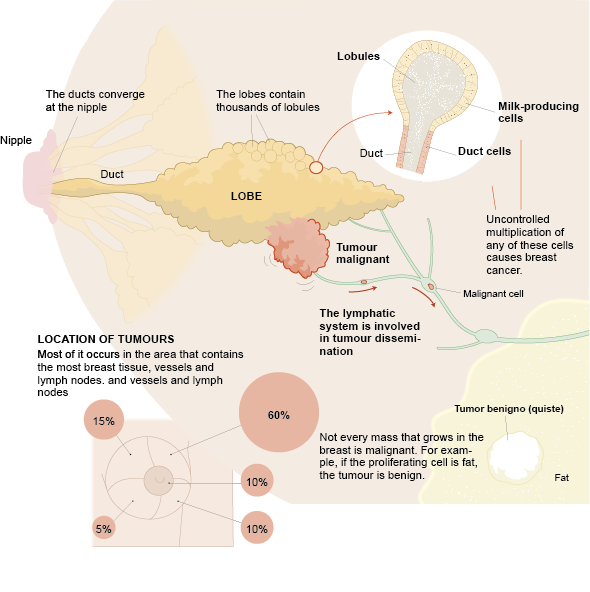 Detalle de una mama con cáncer.
